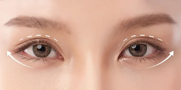 Cat-mi-mat-bi-tron-co-sua-duoc-khong