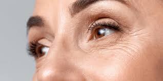 cắt mí có hết nhăn đuôi mắt không