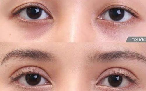 nhấn mí mắt có tốt không