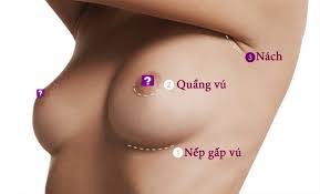 nâng ngực đường quầng