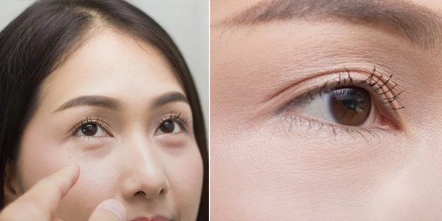 cắt mí dưới